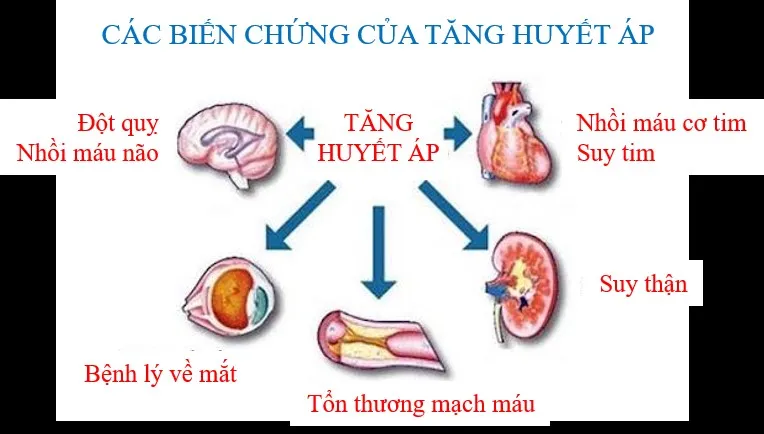 Cao huyết áp là gì và những nguy cơ tiềm ẩn